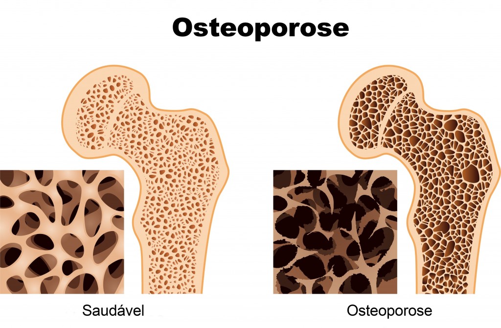 osteoporose